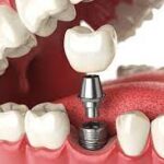 Pros and Cons of Dental Implants for Replacing Teeth