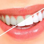 Teeth-Whitening