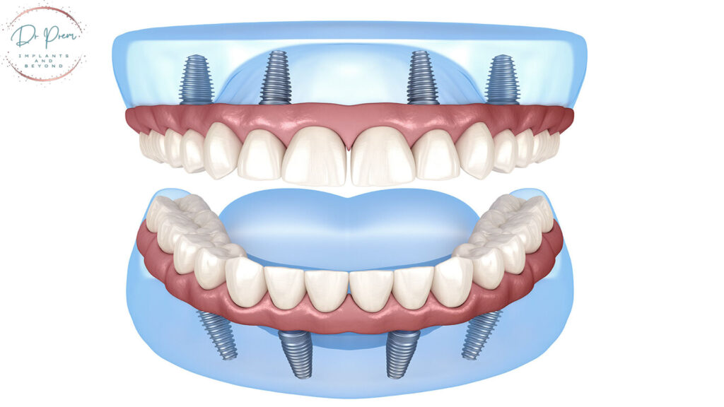 Maintaining Oral Hygiene with Dental Implants: Tips for a Healthy Smile