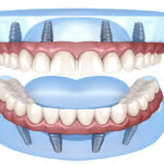 Maintaining Oral Hygiene with Dental Implants: Tips for a Healthy Smile