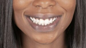 Dark Gums