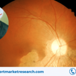 Age-Related Macular Degeneration (AMD) Market