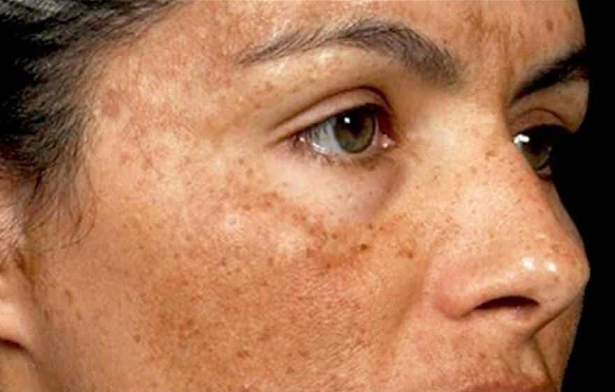 Diffuse Pigmentation