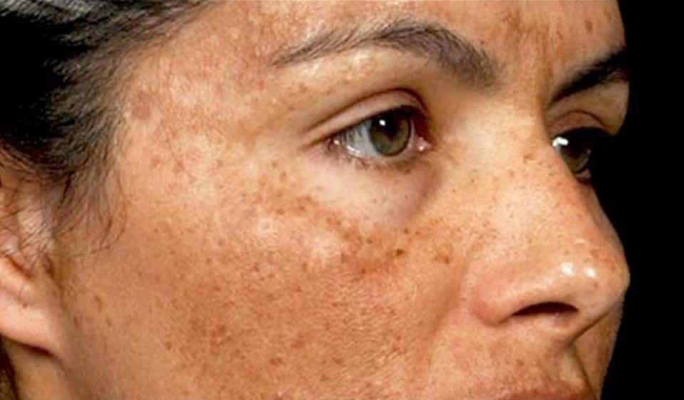 Diffuse Pigmentation