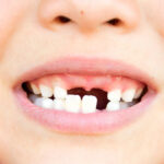 How to Restore Your Smile: Effective Solutions for Broken and Missing Teeth