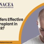 Which Clinic Offers Effective Hair Transplant In Delhi NCR