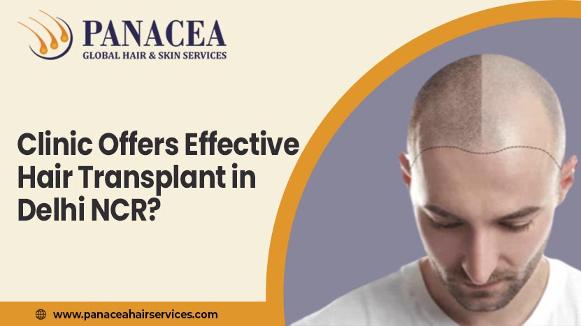 Which Clinic Offers Effective Hair Transplant In Delhi NCR