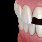 Cosmetic Dentistry Procedures and Their Role in Baton Rouge, LA