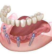 Dental Implants in Dumfries