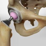 Hip Replacement Market