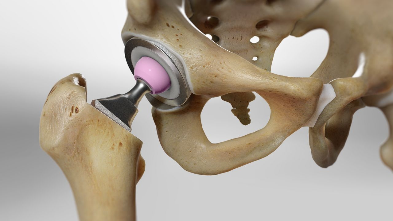 Hip Replacement Market