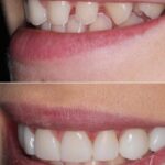 dental veneers Brisbane