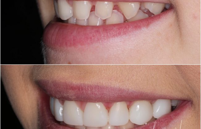 dental veneers Brisbane