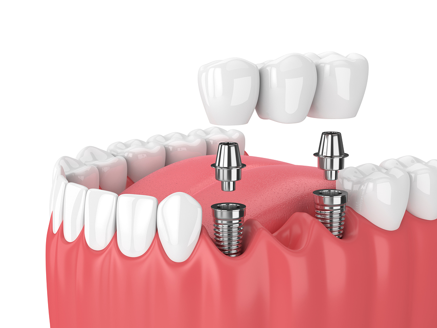 Replacing Missing Teeth