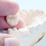 Same Day Crowns in Arkadelphia, AR: A Convenient Dental Solution