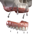 Transform Your Smile with Full Arch Implants in Palm Springs, CA