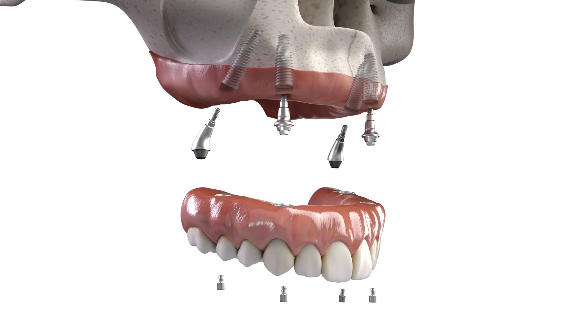 Transform Your Smile with Full Arch Implants in Palm Springs, CA