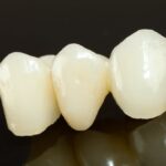 Understanding Dental Crowns in Granbury, TX