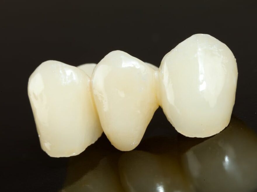 Understanding Dental Crowns in Granbury, TX