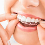 Unlock Your Perfect Smile: Invisible Aligners