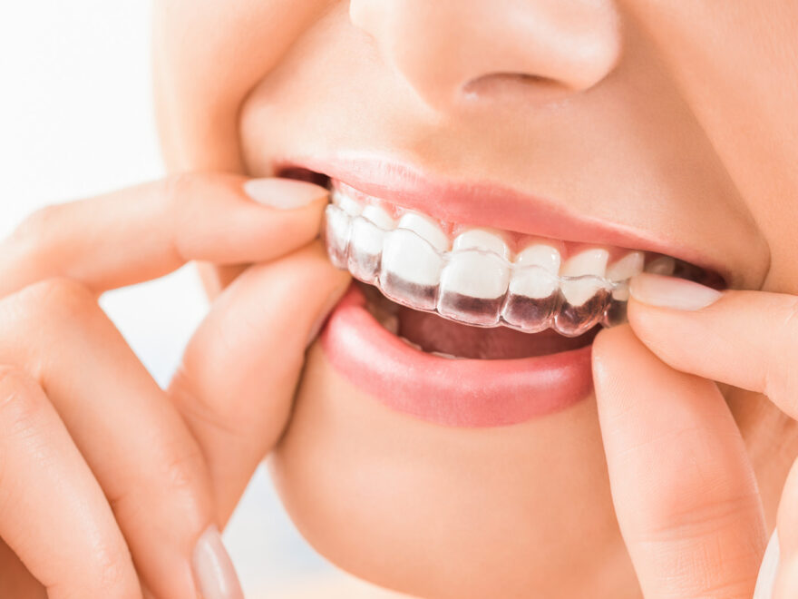 Unlock Your Perfect Smile: Invisible Aligners