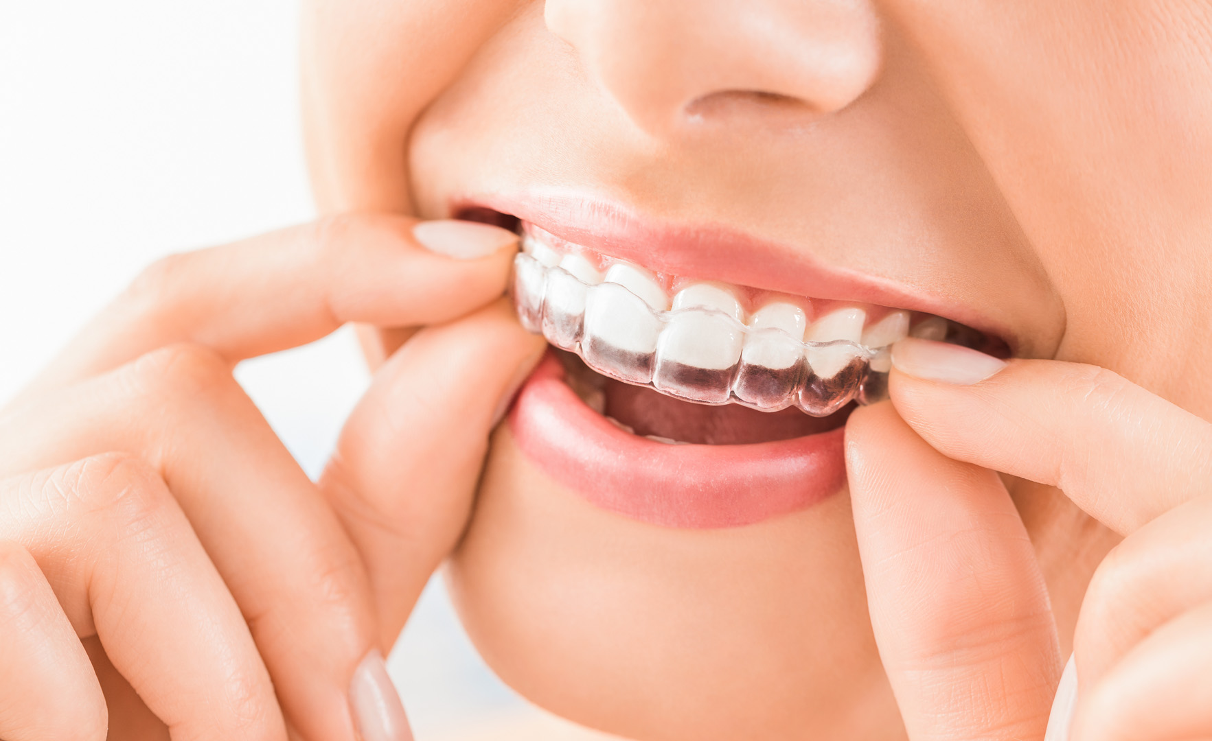 Unlock Your Perfect Smile: Invisible Aligners