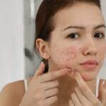 Spot-Free Success: Your Acne-Free Journey | Acne treatment