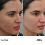 laser resurfacing dubai