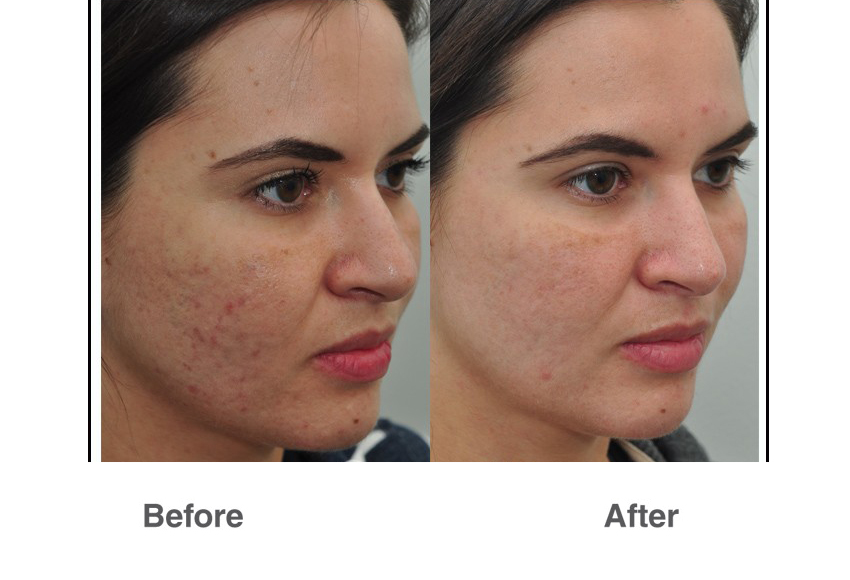 laser resurfacing dubai