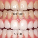 teeth-whitening