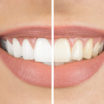 teeth whitening singapore