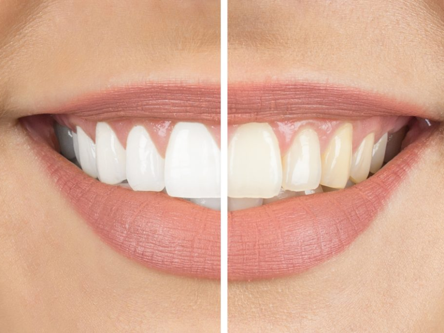 teeth whitening singapore