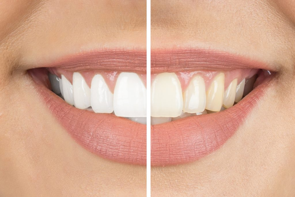 teeth whitening singapore