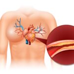 Aortic Valve Rеplacеmеnt Surgеry