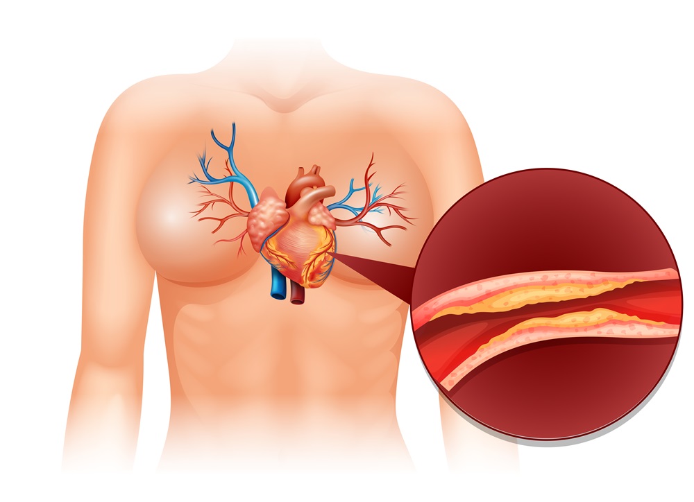 Aortic Valve Rеplacеmеnt Surgеry