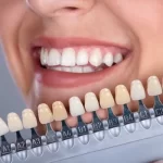 Enhance Your Dental Aesthetics with Customized Dental Veneers