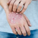 natural home remedies for psoriasis