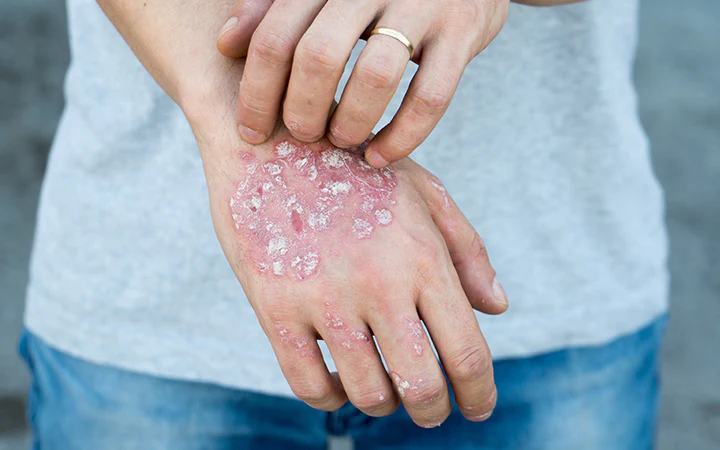 natural home remedies for psoriasis