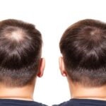 hair transplant in Delhi