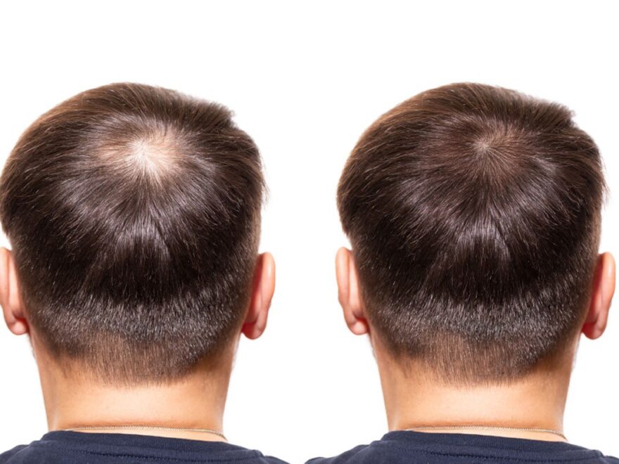 hair transplant in Delhi