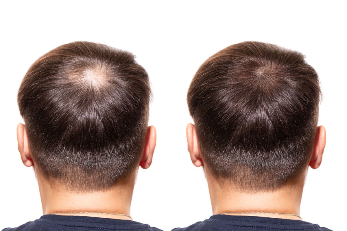 hair transplant in Delhi