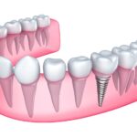 How Dental Implants Improve Dietary Habits