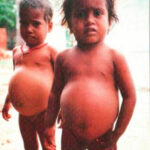 Kwashiorkor