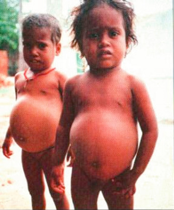 Kwashiorkor