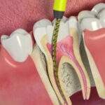 Demystifying Root Canal Therapy Steps