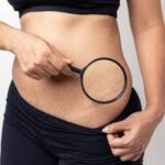 Stretch Marks Removal in Dubai