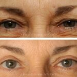 eyelid surgery in dubai