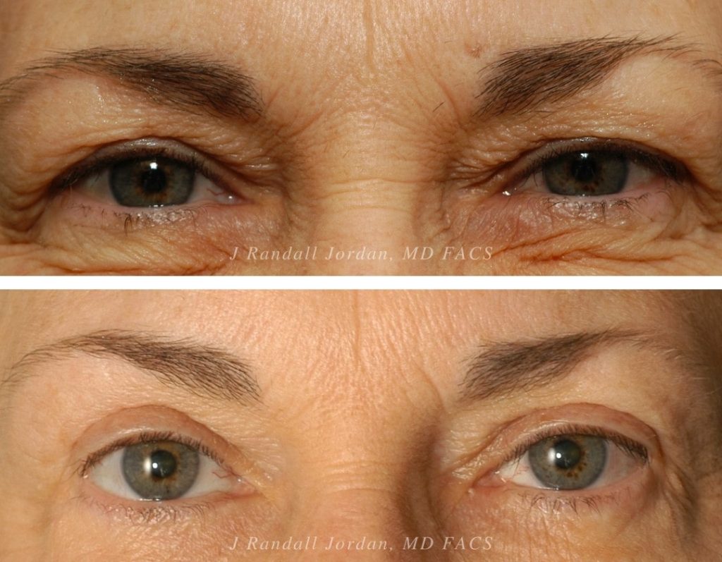 eyelid surgery in dubai