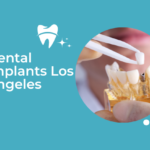 dental implants los angeles