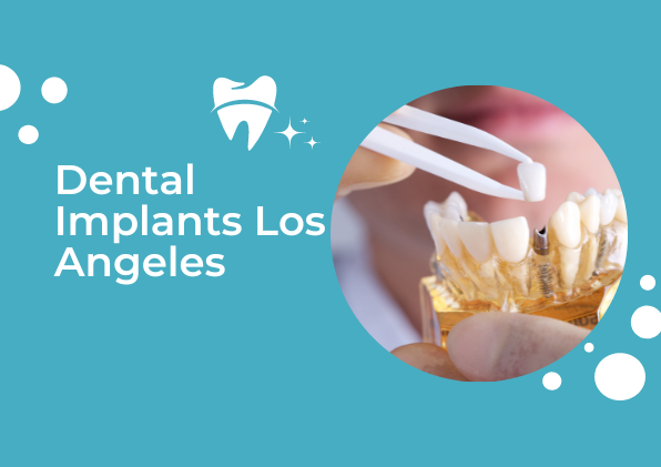 dental implants los angeles